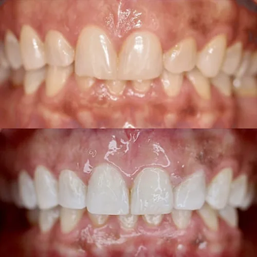 Before-and-after smile transformation by Dr. Pia Lieb at Cosmetic Dentistry Center NYC, case 31