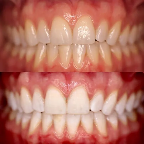 Before-and-after smile transformation by Dr. Pia Lieb at Cosmetic Dentistry Center NYC, case 2