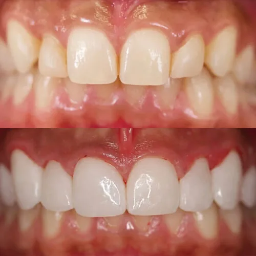 Before-and-after smile transformation by Dr. Pia Lieb at Cosmetic Dentistry Center NYC, case 32