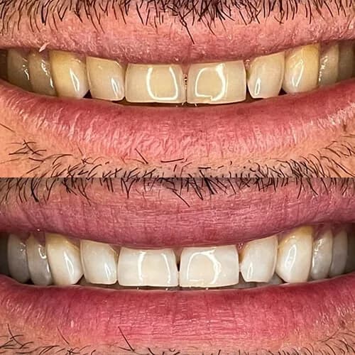 Before-and-after smile transformation by Dr. Pia Lieb at Cosmetic Dentistry Center NYC, case 7