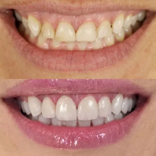 Before-and-after smile transformation by Dr. Pia Lieb at Cosmetic Dentistry Center NYC, case 8