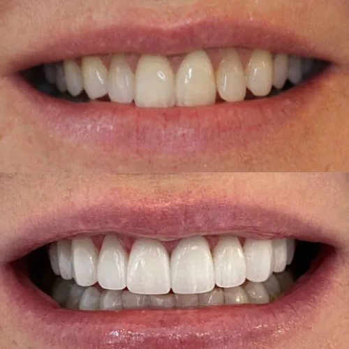 Before-and-after smile transformation by Dr. Pia Lieb at Cosmetic Dentistry Center NYC, case 11