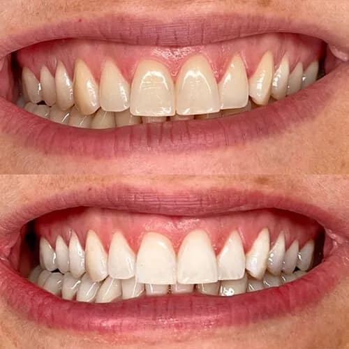 Before-and-after smile transformation by Dr. Pia Lieb at Cosmetic Dentistry Center NYC, case 13