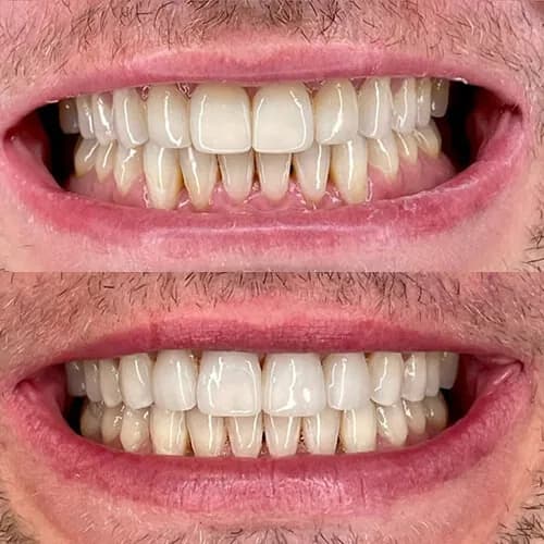 Before-and-after smile transformation by Dr. Pia Lieb at Cosmetic Dentistry Center NYC, case 14