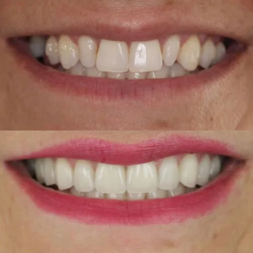 Before-and-after smile transformation by Dr. Pia Lieb at Cosmetic Dentistry Center NYC, case 6