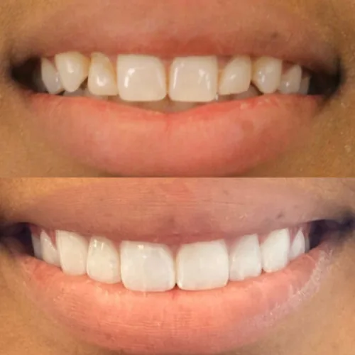 Before-and-after smile transformation by Dr. Pia Lieb at Cosmetic Dentistry Center NYC, case 15