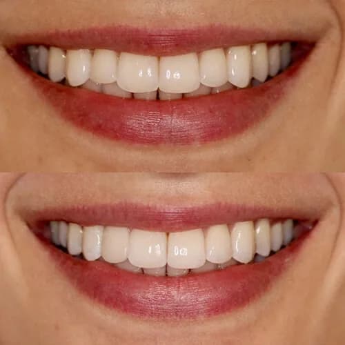 Before-and-after smile transformation by Dr. Pia Lieb at Cosmetic Dentistry Center NYC, case 16