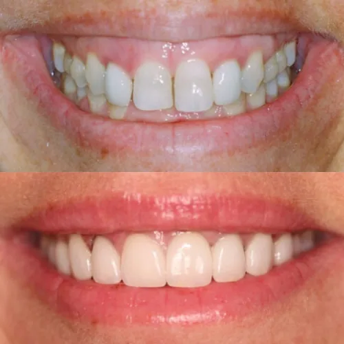 Before-and-after smile transformation by Dr. Pia Lieb at Cosmetic Dentistry Center NYC, case 10