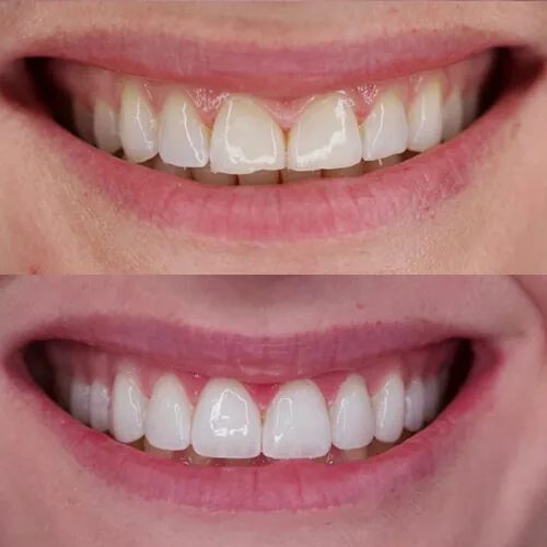 Before-and-after smile transformation by Dr. Pia Lieb at Cosmetic Dentistry Center NYC, case 17