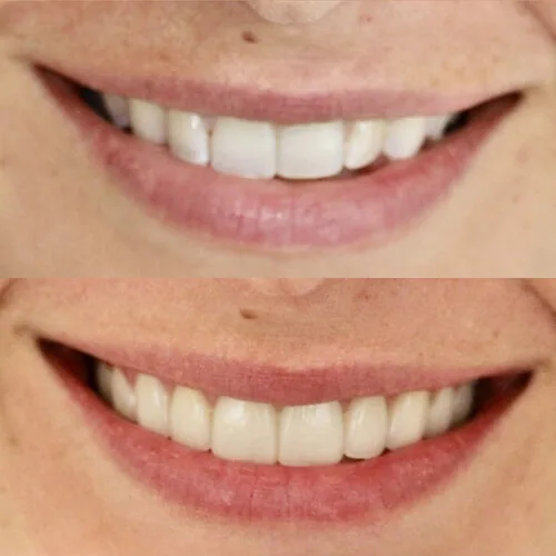 Before-and-after smile transformation by Dr. Pia Lieb at Cosmetic Dentistry Center NYC, case 18