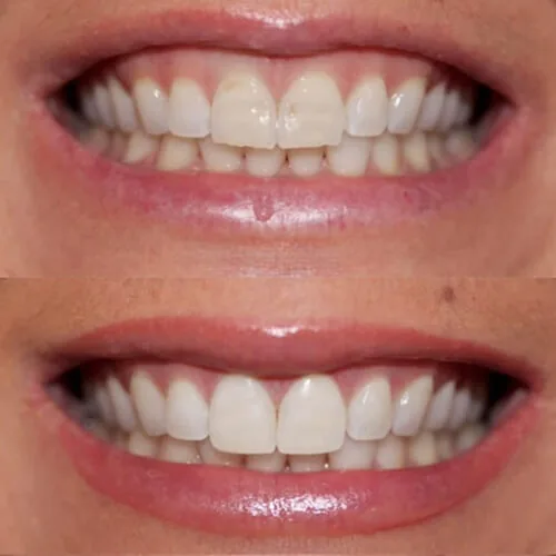 Before-and-after smile transformation by Dr. Pia Lieb at Cosmetic Dentistry Center NYC, case 9