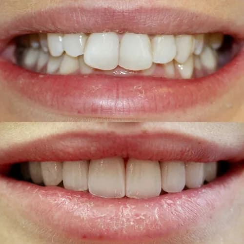 Before-and-after smile transformation by Dr. Pia Lieb at Cosmetic Dentistry Center NYC, case 19