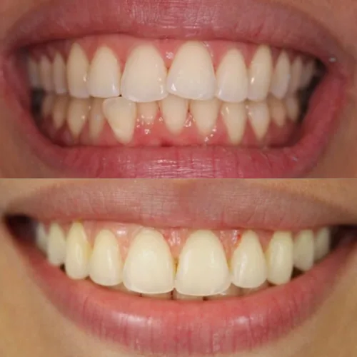 Before-and-after smile transformation by Dr. Pia Lieb at Cosmetic Dentistry Center NYC, case 12