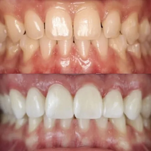 Before-and-after smile transformation by Dr. Pia Lieb at Cosmetic Dentistry Center NYC, case 5