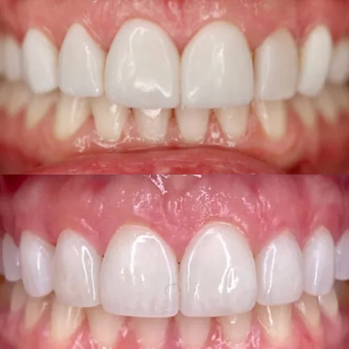 Before-and-after smile transformation by Dr. Pia Lieb at Cosmetic Dentistry Center NYC, case 20