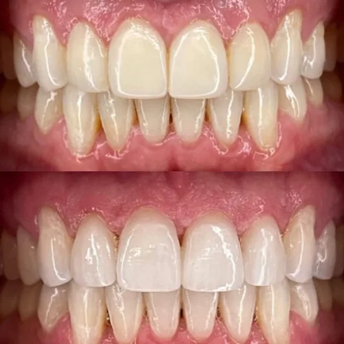 Before-and-after smile transformation by Dr. Pia Lieb at Cosmetic Dentistry Center NYC, case 21