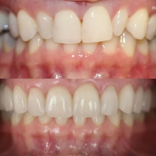 Before-and-after smile transformation by Dr. Pia Lieb at Cosmetic Dentistry Center NYC, case 23