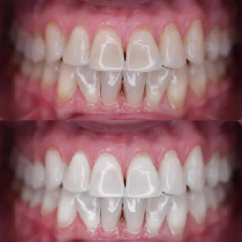 Before-and-after smile transformation by Dr. Pia Lieb at Cosmetic Dentistry Center NYC, case 24