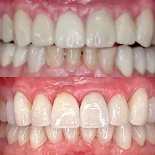 Before-and-after smile transformation by Dr. Pia Lieb at Cosmetic Dentistry Center NYC, case 25