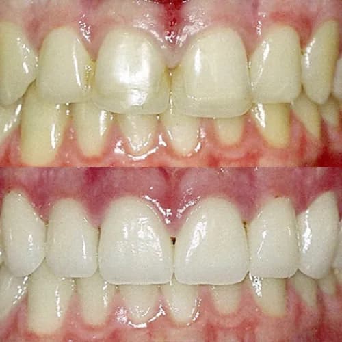 Before-and-after smile transformation by Dr. Pia Lieb at Cosmetic Dentistry Center NYC, case 4