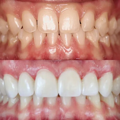 Before-and-after smile transformation by Dr. Pia Lieb at Cosmetic Dentistry Center NYC, case 3