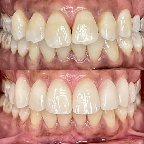 Before-and-after smile transformation by Dr. Pia Lieb at Cosmetic Dentistry Center NYC, case 26