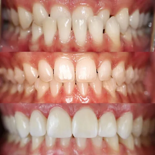 Before-and-after smile transformation by Dr. Pia Lieb at Cosmetic Dentistry Center NYC, case 28