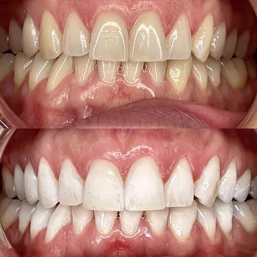 Before-and-after smile transformation by Dr. Pia Lieb at Cosmetic Dentistry Center NYC, case 29