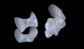 Porcelain Inlay Onlay — cosmetic dentistry service at Cosmetic Dentistry Center NYC