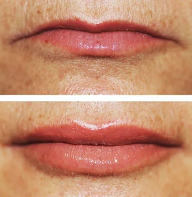 Botox & Lip Enhancement by Dr. Pia Lieb at Cosmetic Dentistry Center NYC — photo 1