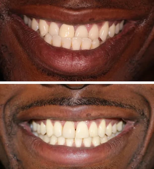 Invisalign by Dr. Pia Lieb at Cosmetic Dentistry Center NYC — photo 5