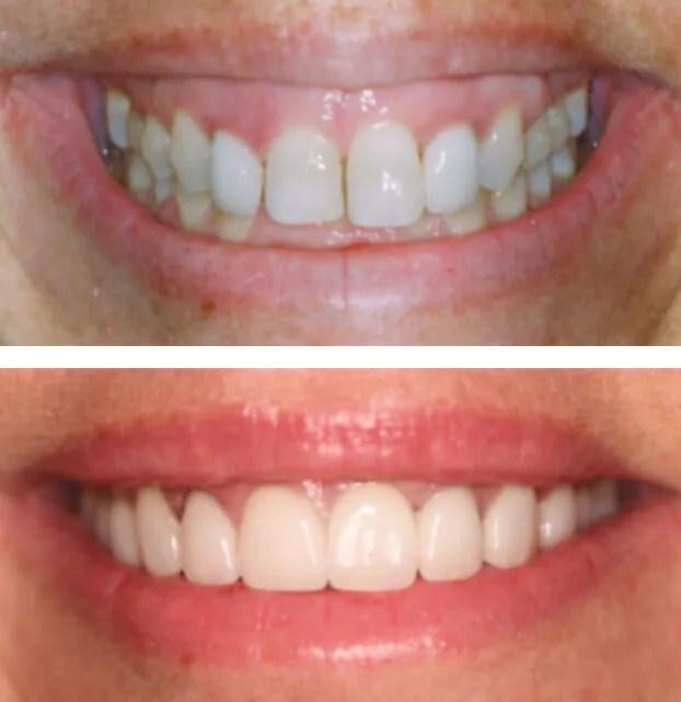 Botox & Lip Enhancement by Dr. Pia Lieb at Cosmetic Dentistry Center NYC — photo 3