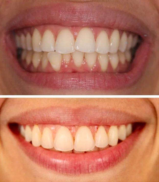 Invisalign by Dr. Pia Lieb at Cosmetic Dentistry Center NYC — photo 4