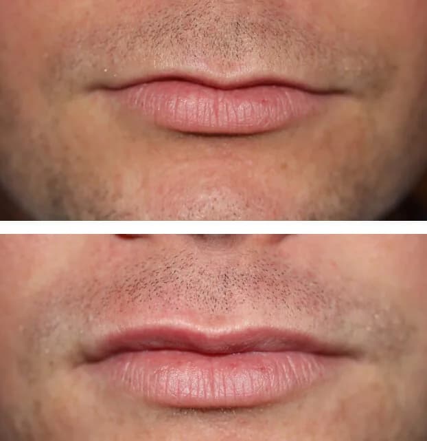 Botox & Lip Enhancement by Dr. Pia Lieb at Cosmetic Dentistry Center NYC — photo 2