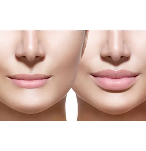 Botox & Lip Enhancement by Dr. Pia Lieb at Cosmetic Dentistry Center NYC — photo 4