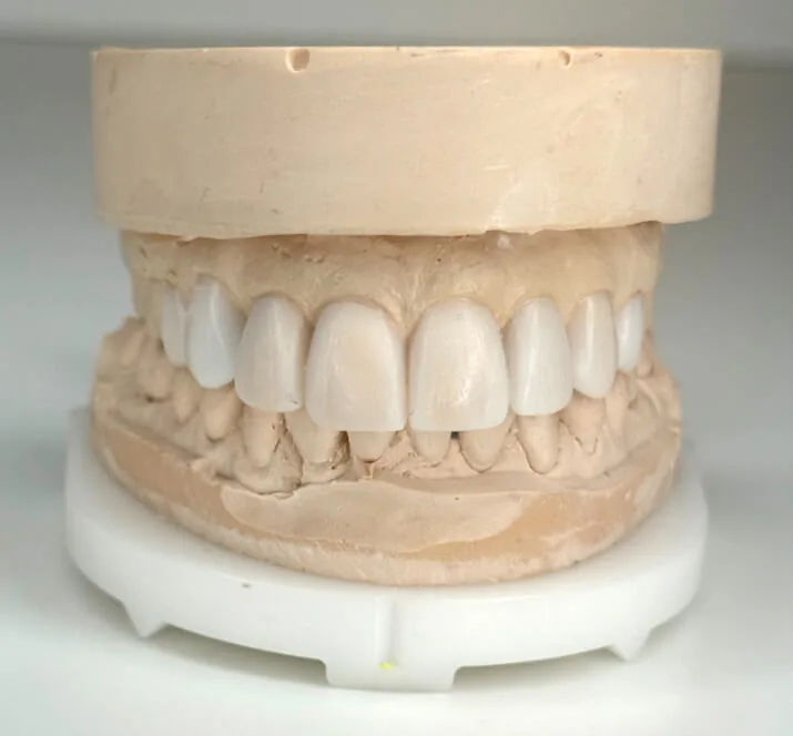 The Dr. Pia Method™ result by Dr. Pia Lieb at Cosmetic Dentistry Center NYC in New York