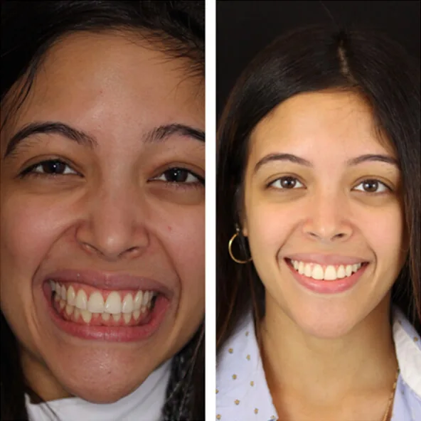 Invisalign by Dr. Pia Lieb at Cosmetic Dentistry Center NYC — photo 3