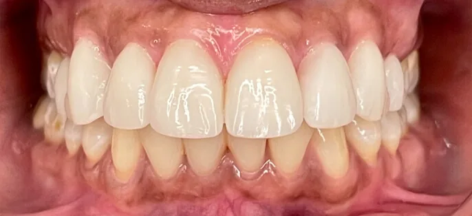 The Dr. Pia Method™ result by Dr. Pia Lieb at Cosmetic Dentistry Center NYC in New York