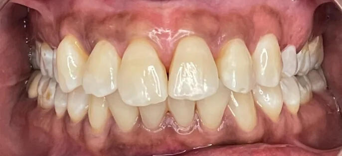 The Dr. Pia Method™ result by Dr. Pia Lieb at Cosmetic Dentistry Center NYC in New York