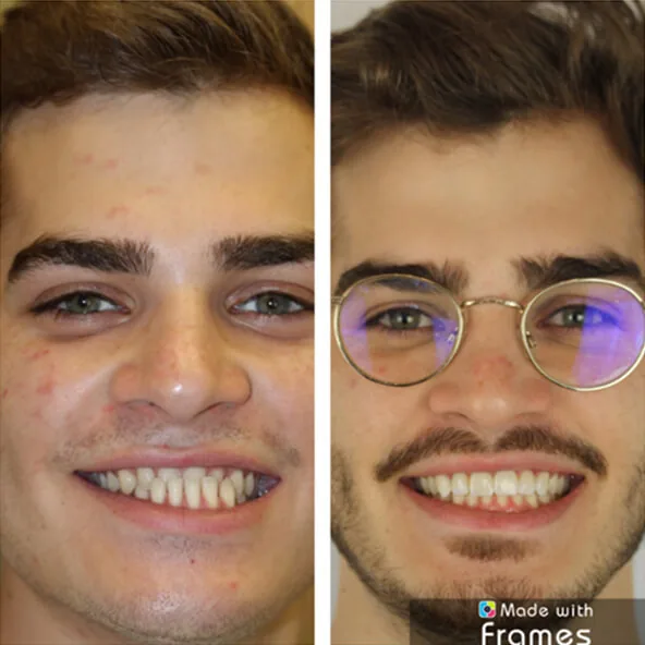 Invisalign by Dr. Pia Lieb at Cosmetic Dentistry Center NYC — photo 1