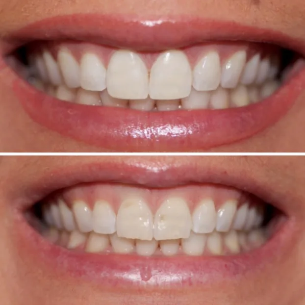 Dental Bonding & Contouring result by Dr. Pia Lieb at Cosmetic Dentistry Center NYC in New York