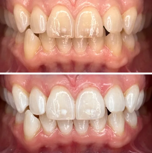 Dental Bonding & Contouring result by Dr. Pia Lieb at Cosmetic Dentistry Center NYC in New York