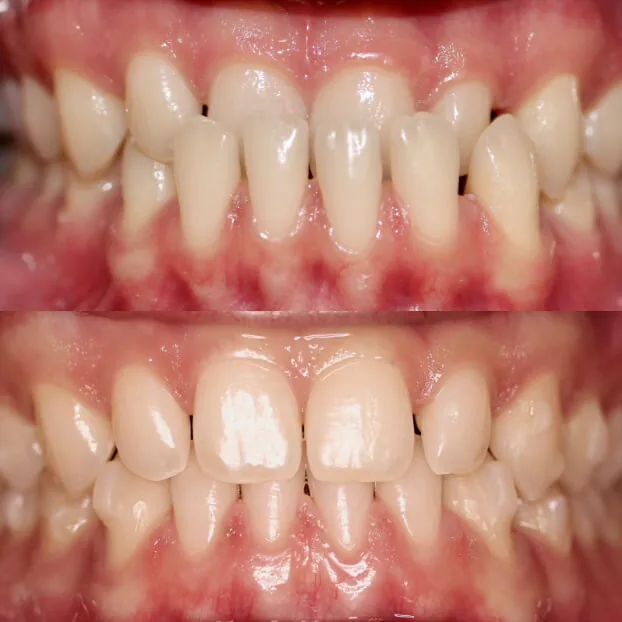 Invisalign by Dr. Pia Lieb at Cosmetic Dentistry Center NYC — photo 7