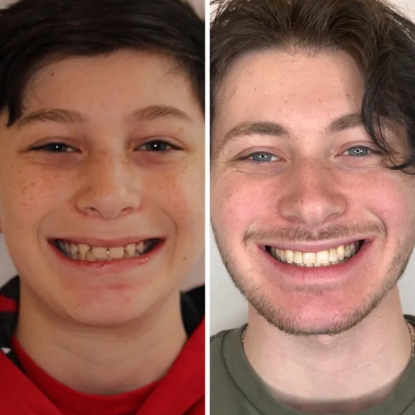Invisalign by Dr. Pia Lieb at Cosmetic Dentistry Center NYC — photo 2