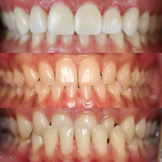 Invisalign by Dr. Pia Lieb at Cosmetic Dentistry Center NYC — photo 6