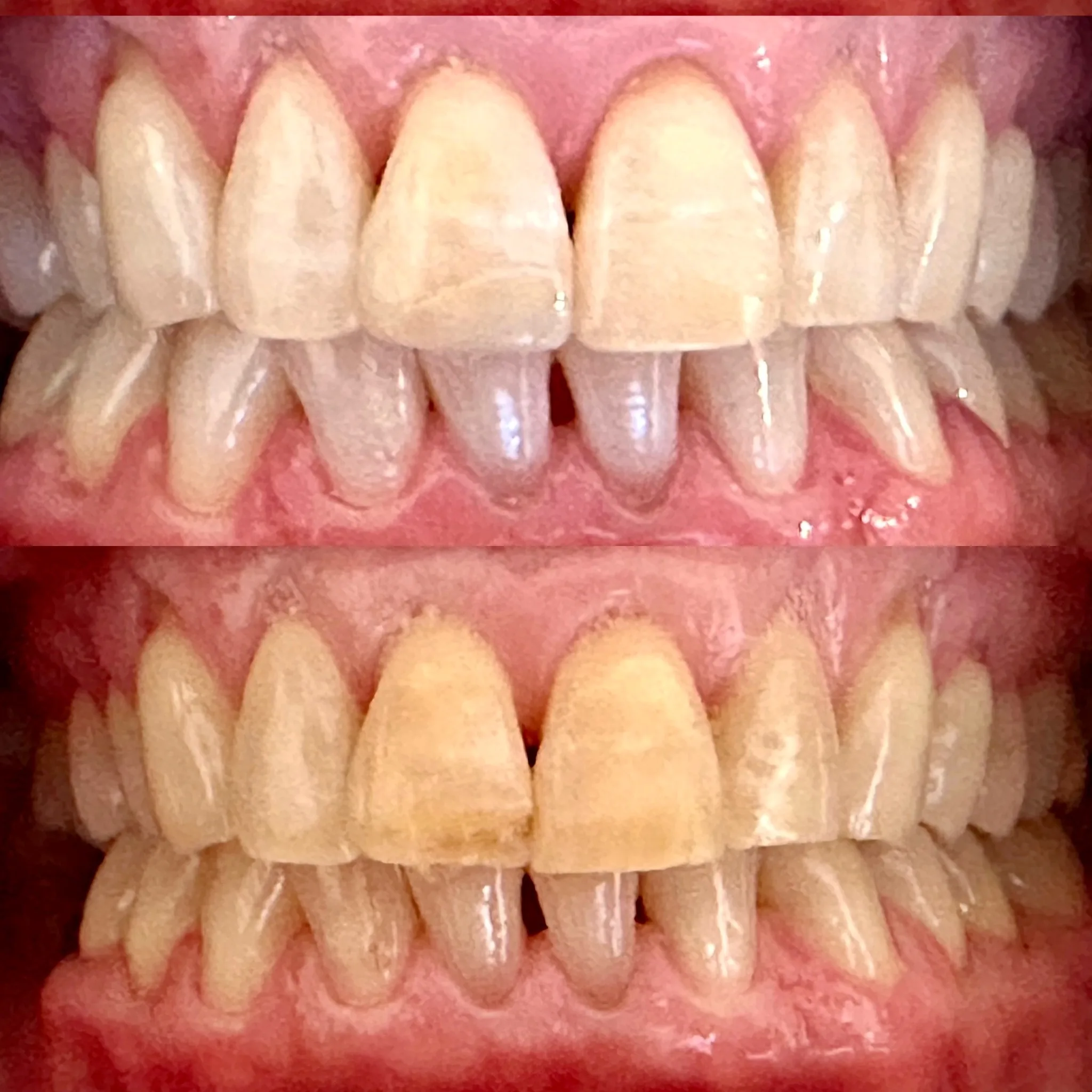 LaserSmile™ Teeth Whitening by Dr. Pia Lieb at Cosmetic Dentistry Center NYC — photo 5