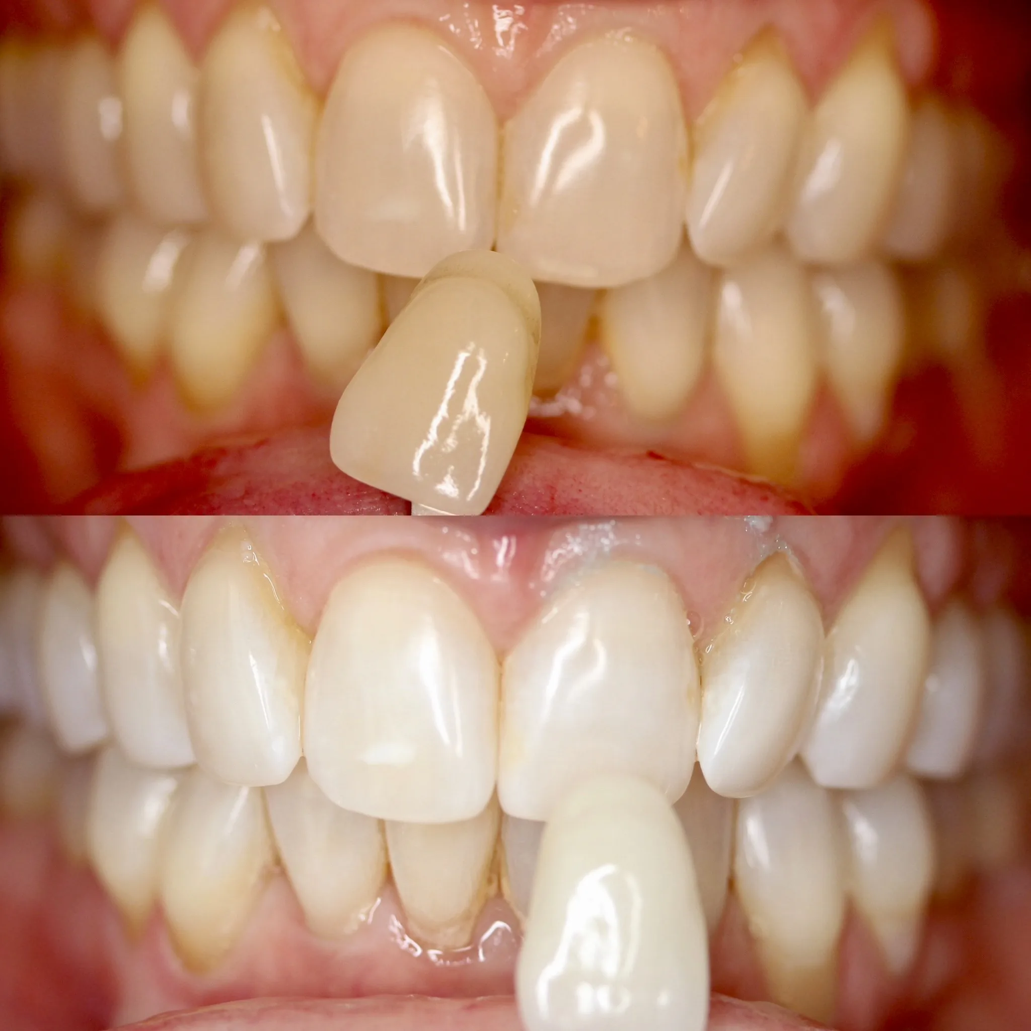 LaserSmile™ Teeth Whitening by Dr. Pia Lieb at Cosmetic Dentistry Center NYC — photo 2
