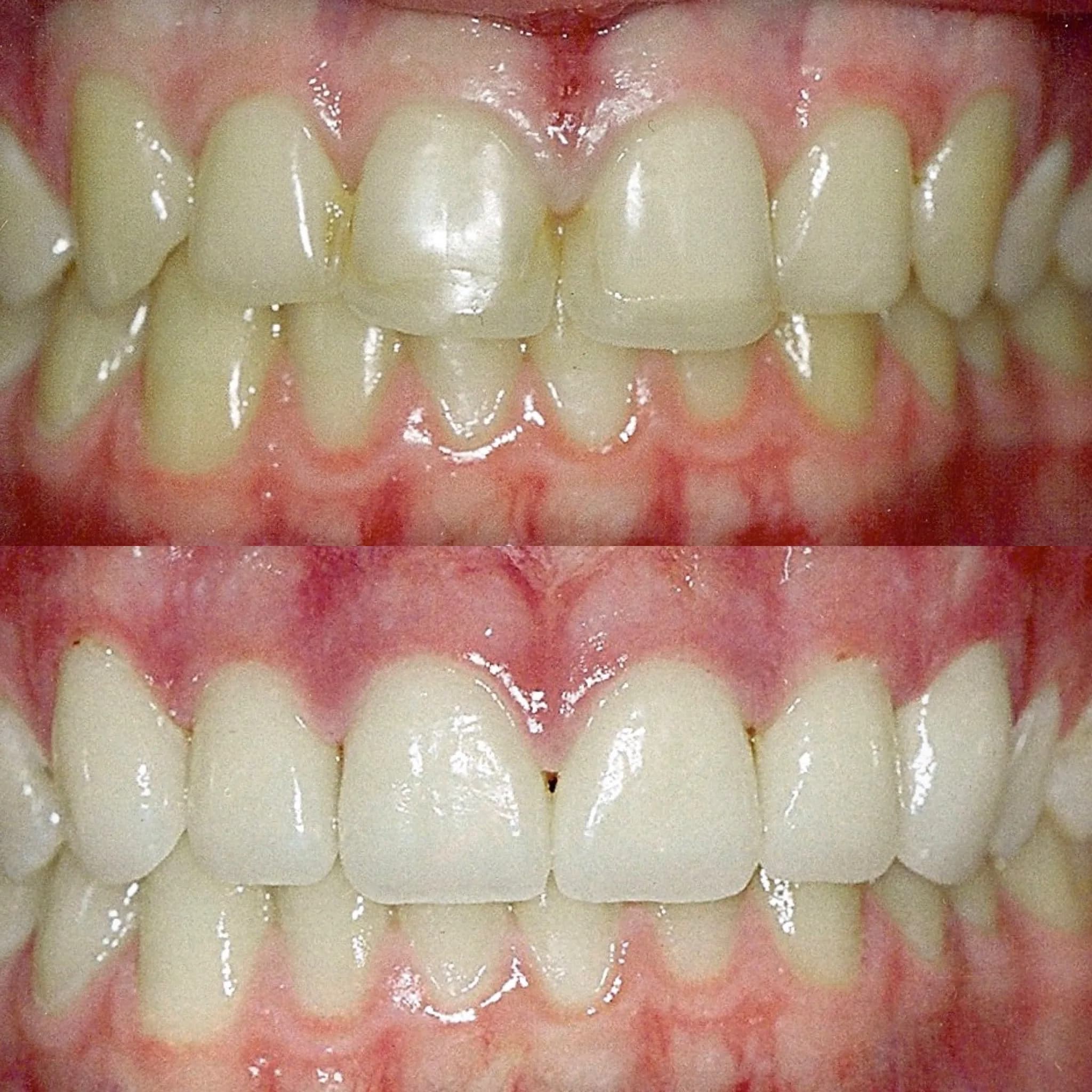 Porcelain Veneers & No-Drill Veneers by Dr. Pia Lieb at Cosmetic Dentistry Center NYC — photo 1