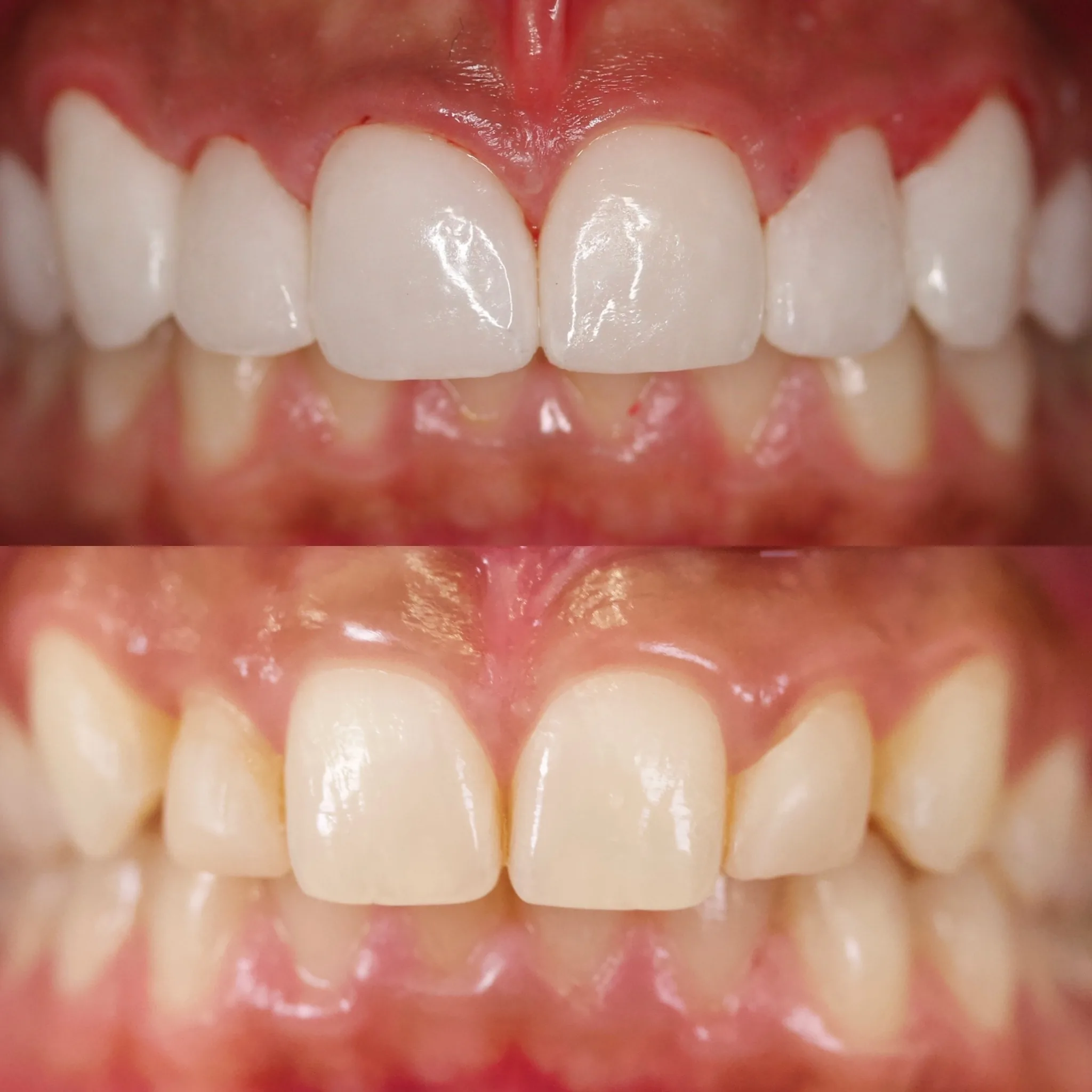 Porcelain Veneers & No-Drill Veneers by Dr. Pia Lieb at Cosmetic Dentistry Center NYC — photo 2