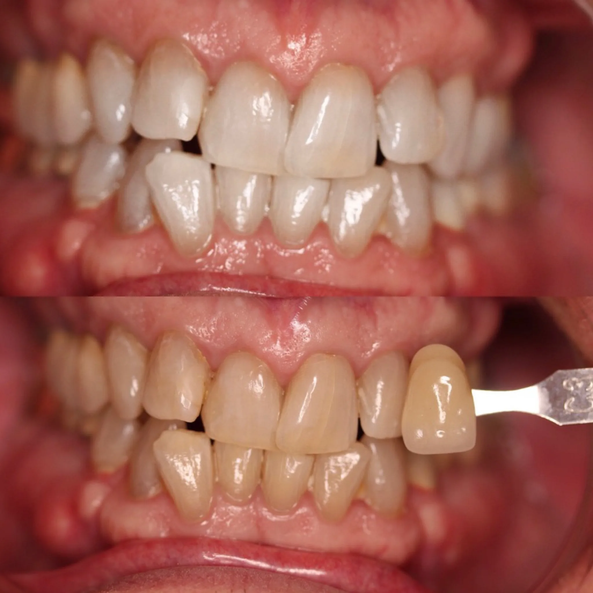 LaserSmile™ Teeth Whitening by Dr. Pia Lieb at Cosmetic Dentistry Center NYC — photo 4